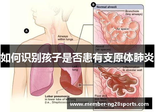 如何识别孩子是否患有支原体肺炎